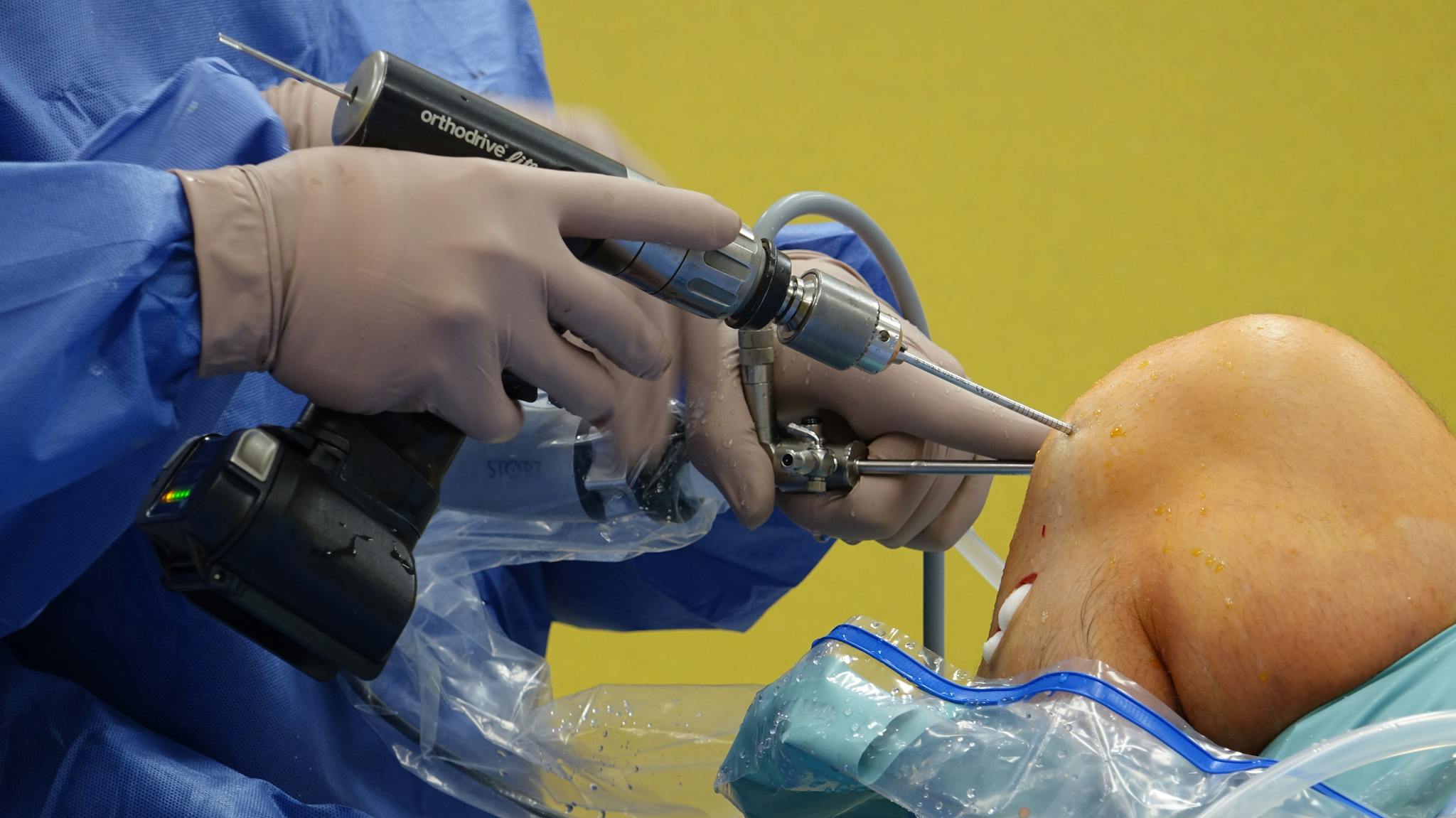 首頁 3 orthopedic surgeon using equipment during knee arthroscopy