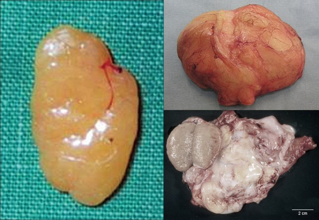 良性脂肪瘤 1 LIpoma 1 1