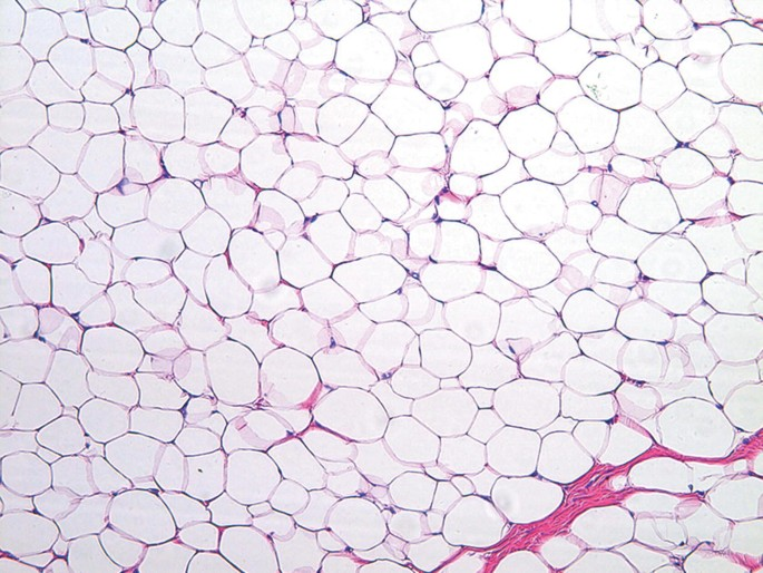 良性脂肪瘤 2 Lipoma 2 1