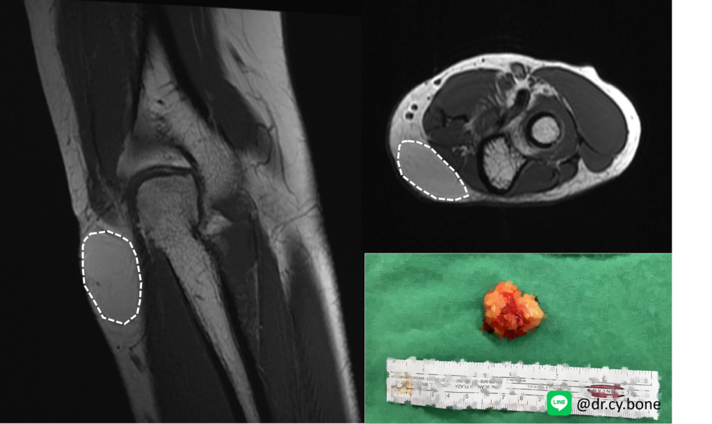 良性脂肪瘤 3 Lipoma 3