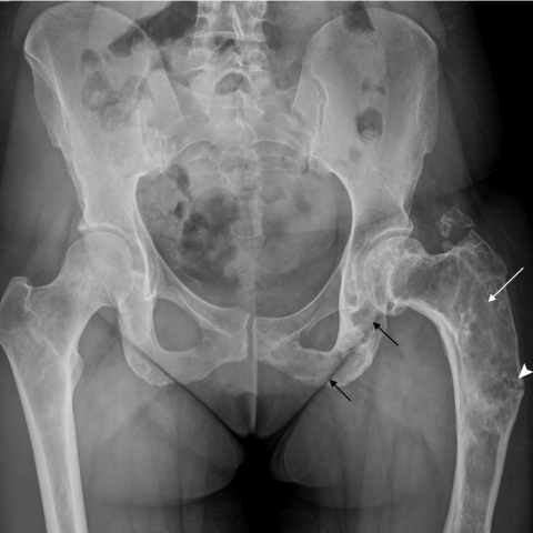 纖維發育不全 Fibrous dysplasia 1 FD X ray 1