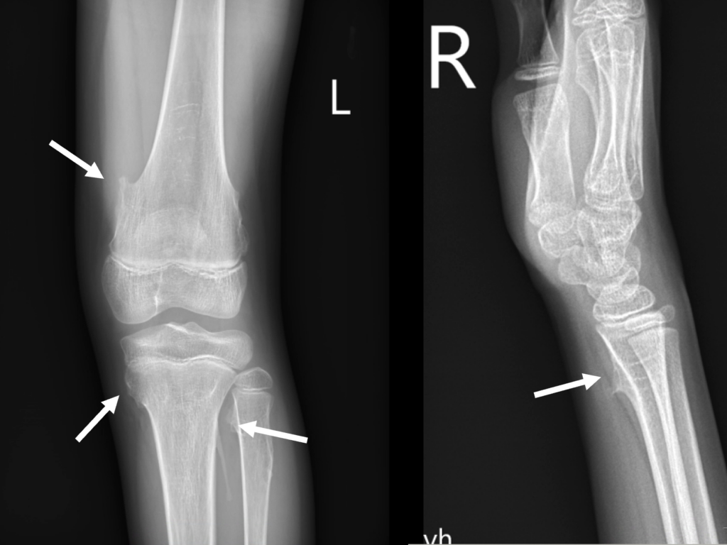 骨軟骨瘤 Osteochondroma 2 OC MHE 1