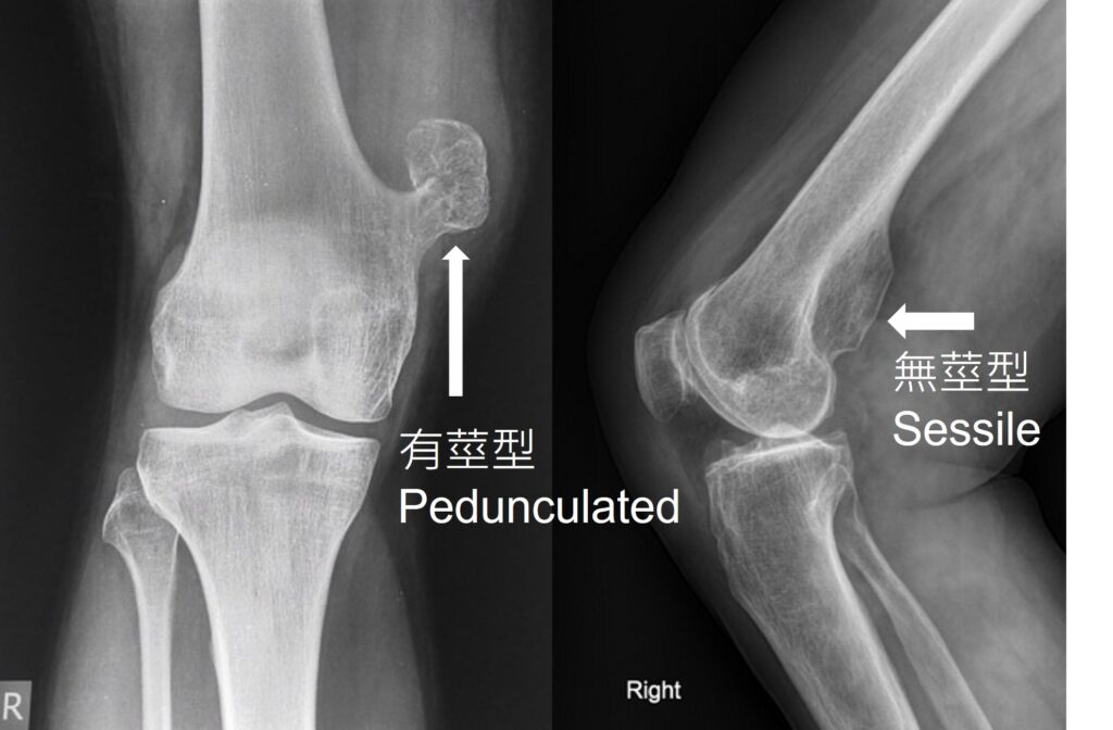 骨軟骨瘤 Osteochondroma 1 osteochondroma 莖 1
