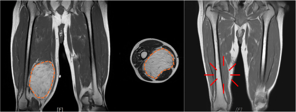脂肪肉瘤 Liposarcoma 1 圖片 1 1 1