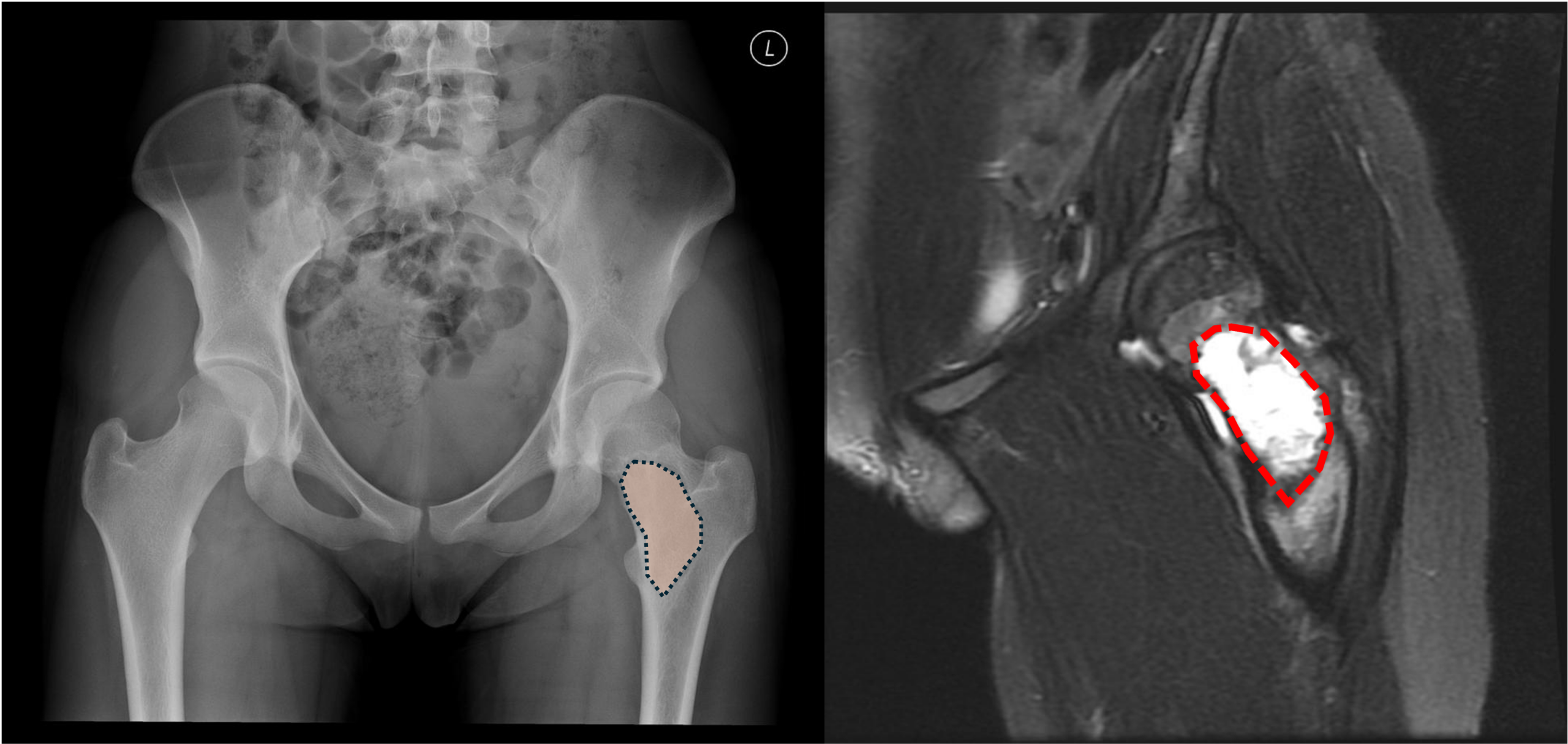 血管性骨囊腫 Aneurysmal bone cyst 1 圖片 1 2 scaled