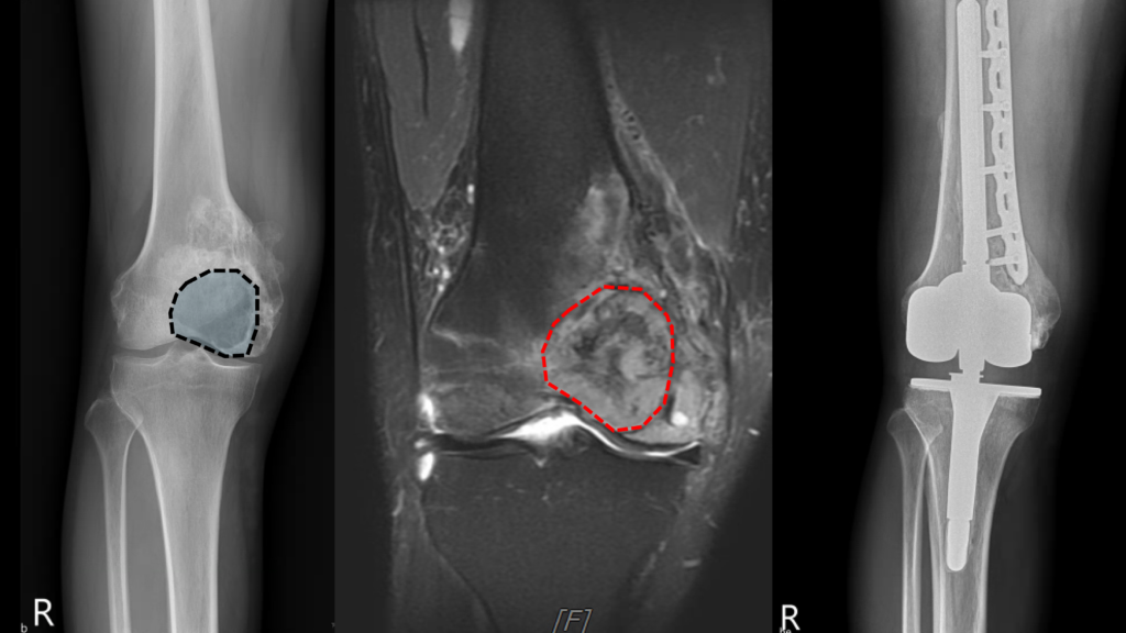 骨巨細胞瘤Giant cell tumor of bone 1 圖片 1 3