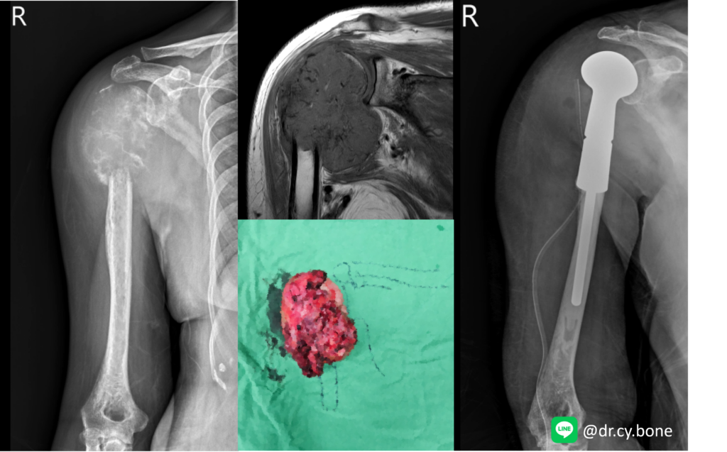 轉移性骨腫瘤 Bone metastasis 2 圖片1