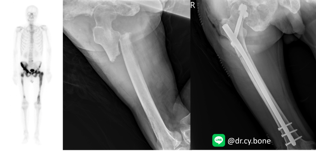 轉移性骨腫瘤 Bone metastasis 1 圖片2 2