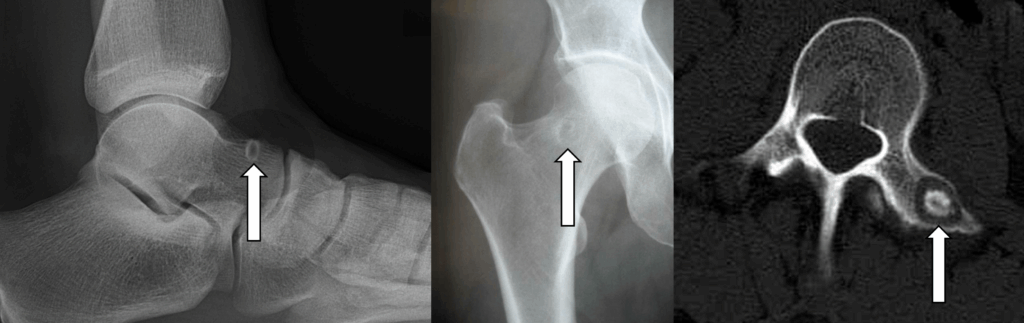 骨樣性骨瘤 Osteoid osteoma 1 圖片1 3