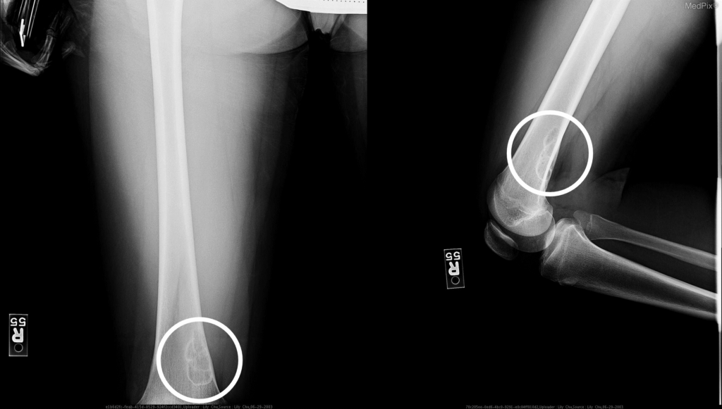 非骨化性纖維瘤 Nonossifying fibroma 1 圖片1 4