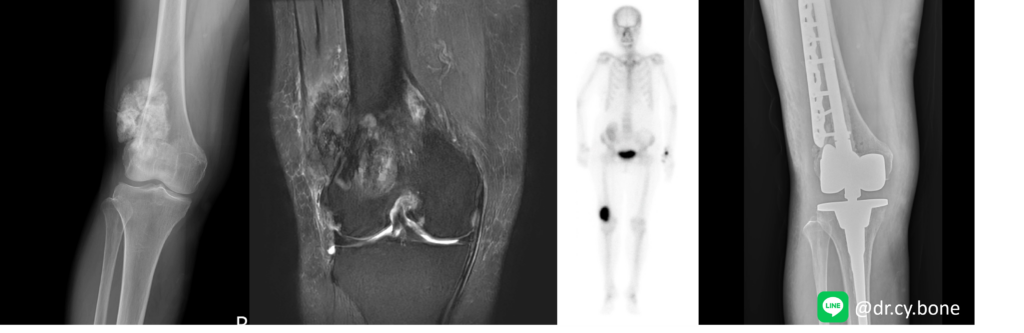 骨肉瘤 Osteosarcoma 1 圖片1 2