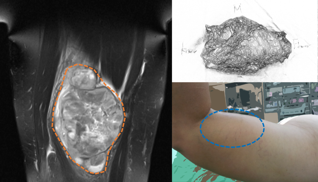 平滑肌肉瘤Leiomyosarcoma 1 圖片1 2