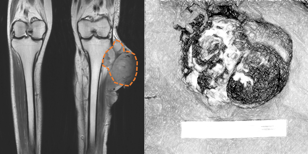 平滑肌肉瘤Leiomyosarcoma 2 圖片2 2