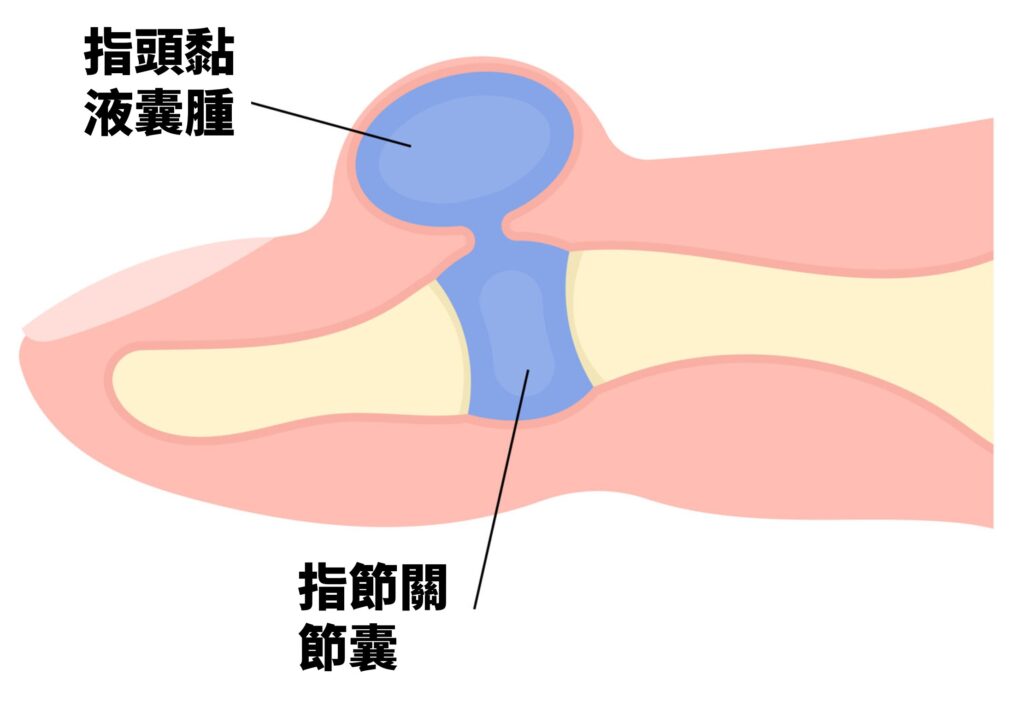 指節黏液囊腫 Digital mucous cyst 1 圖片5 1