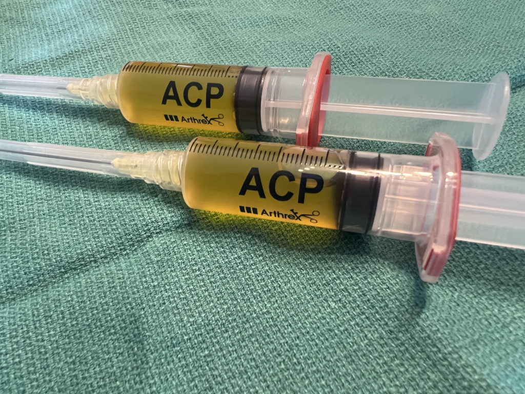 不開刀治療退化性膝關節炎,PRP是好選擇嗎? 1 11 2