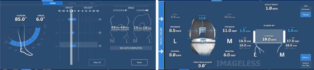 電腦導航 x 機械手臂 x AI 人工關節置換的全新篇章 2 圖片2 1