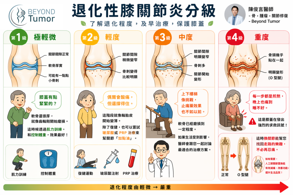 退化性膝關節炎怎麼辦?症狀、分級與治療方式一次看懂 2 OA knee