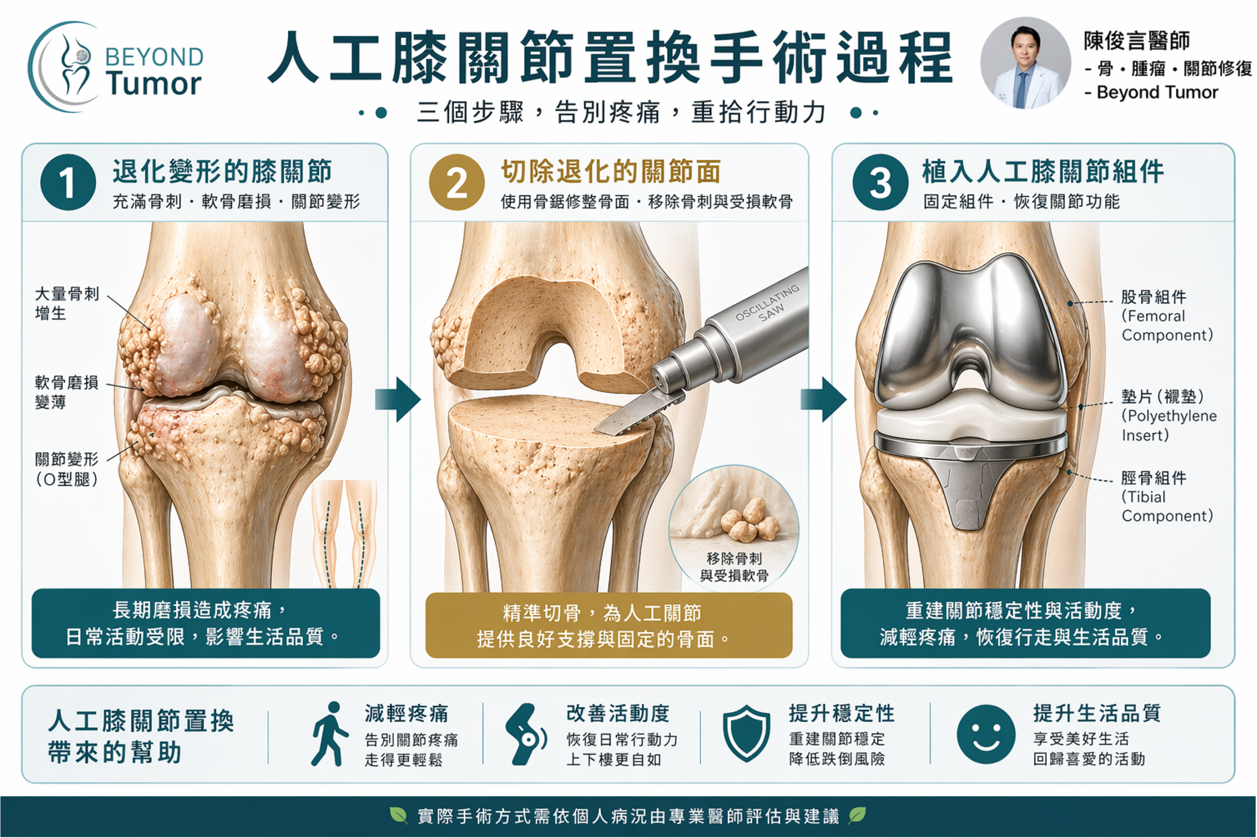 我的膝蓋沒救了嗎?怎樣才需要換關節?骨科醫師老實說 3 圖片 3 scaled