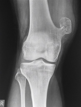 首頁 2 osteochondroma pe